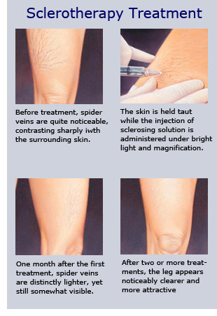 Sclerotherapy and Spider Veins in Charlotte, Vein Experts